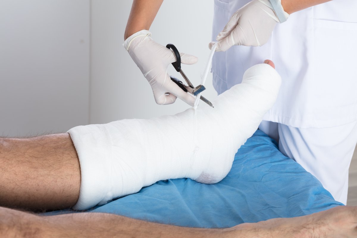 Illustrasjonsbilde av brukket fot. Foto: Mostphotos