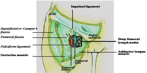 Figur 8.5: Kirurgisk anatomiske grenser av Scarpa’s femorale triangle «i bold». De overfladiske inguinofemorale lymfeknutene er tatt bort (se figur 8.4). De dype femorale lymfeknutene er synlige, idet lamina cribrosa er fjernet, beliggende medialt for for vena femoralis, under planet til den femorale fascie. (Fra Micheletti et al. 2006, s. 11 (Micheletti et al., 2005))