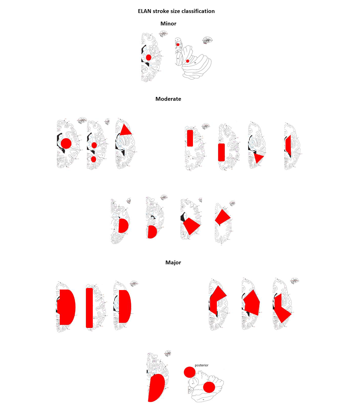 Klassifisering av ulike størrelser av hjerneinfarkter