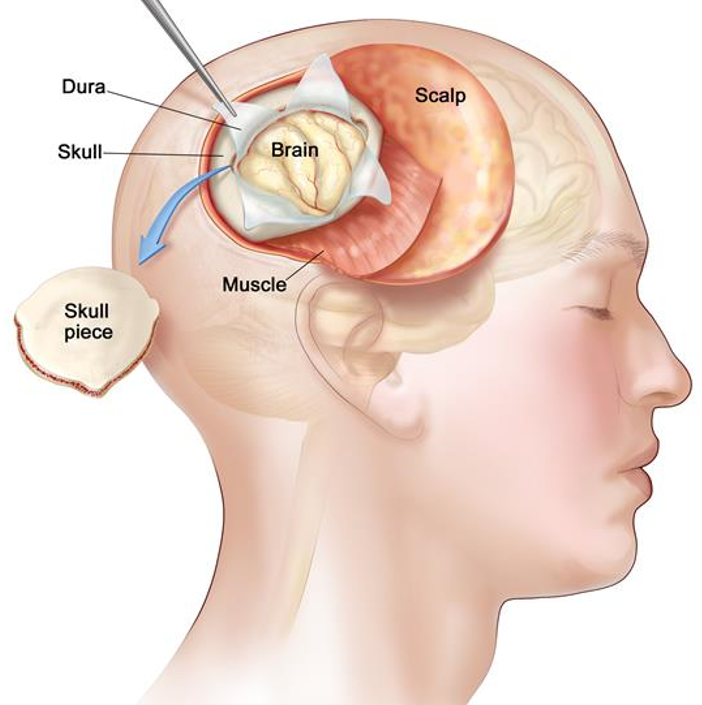 Skjematisk tegning av hodet, med følgende navngitte områder (på engelsk): Dura, Skull, Skull piece, Muscle, Brain, Scalp.