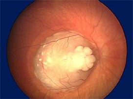 Figur 3: (kjemoterapibehandlet RB)