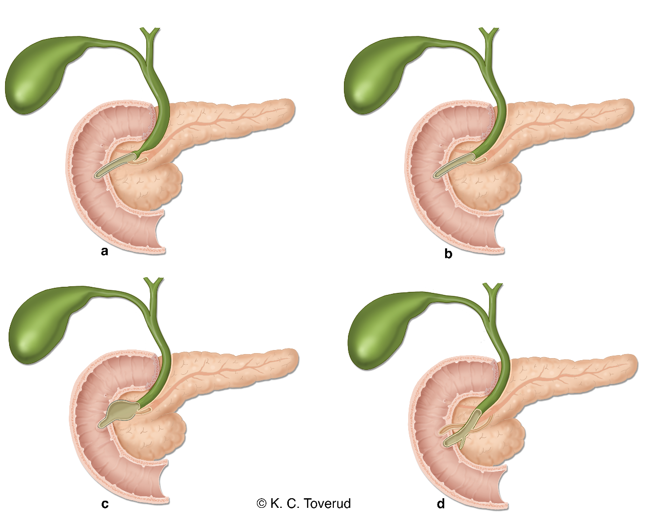 Figur basert på: Urushihara N, Hamada Y, Kamisawa T, et al. Classification of pancreaticobiliary maljunction and clinical features in children. J Hepatobiliary Pancreat Sci 2017; 24(8):449–455.