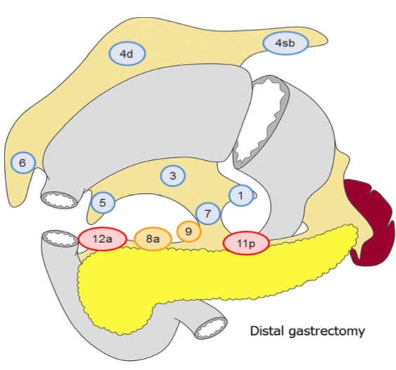 Distal gastrectomy .png