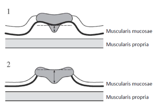 Figur 3: Måling av submucosal infiltrasjon, justert figur ad modum Japanese Society of Cancer of the Colon and Rectum (Japanese Society for Cancer of the Colon and Rectum, 2019).