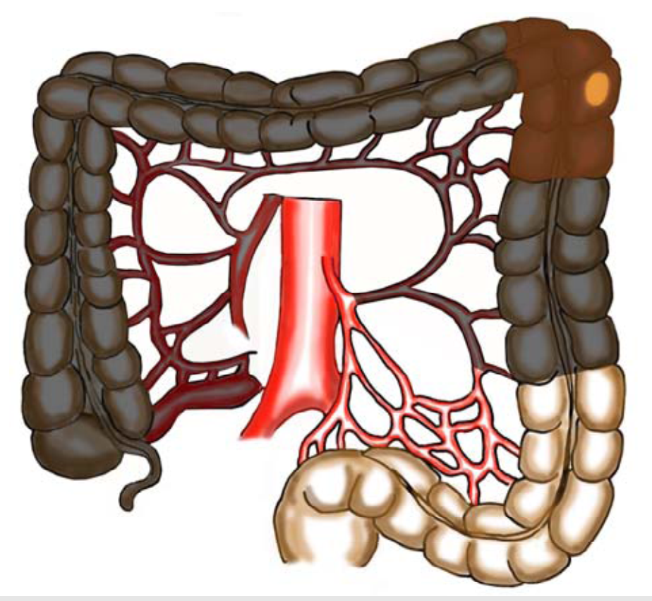 Tykk og endetarmskreft - Cancer i venstre flexur.png