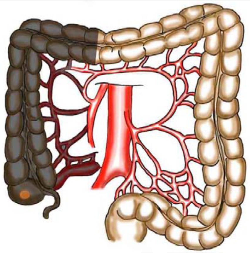 tykk og endetarmskreft - Tumor lokalisasjon.png
