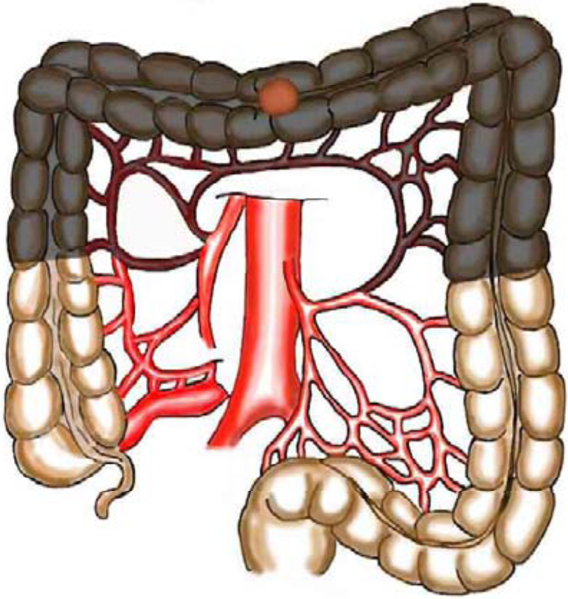 Tykk og endetarmskreft - Cancer i transversum.png