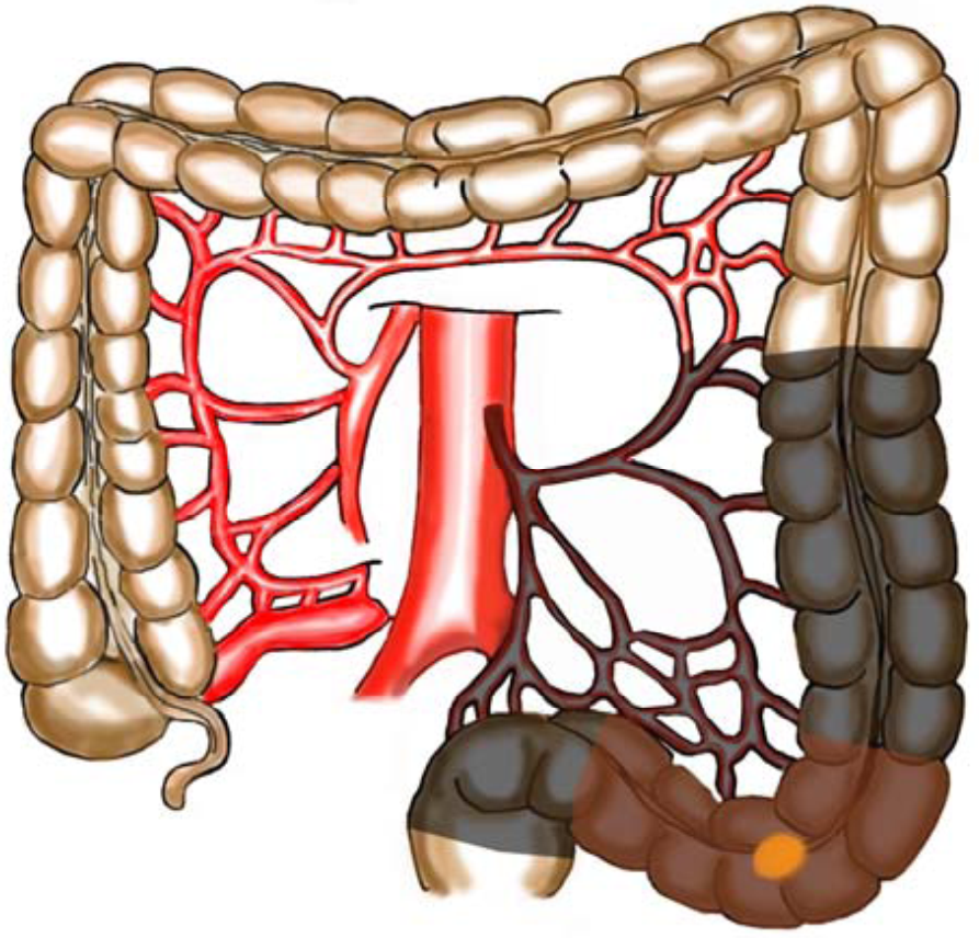 Tykk og endetarmskreft - Cancer i sigmoideum.png