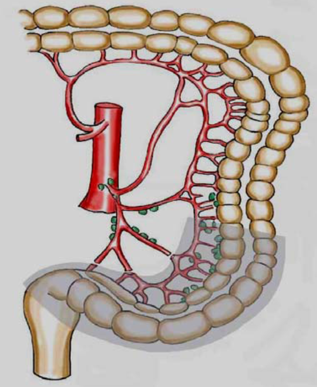 Tykk og endetarmskreft - D1 disseksjon.png