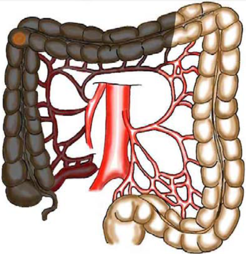 Tykk og endetarmskreft - Cancer i høyre flexur.png