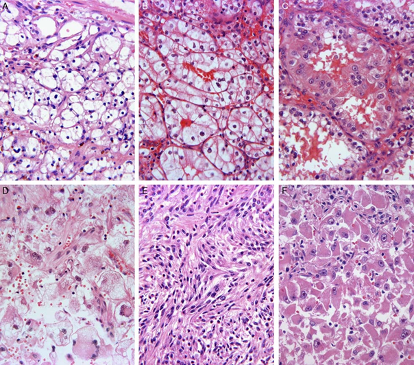Figur 5.1: WHO/ISUP graderingssystemet validert for klarcellet og papillært nyrecellekarsinom