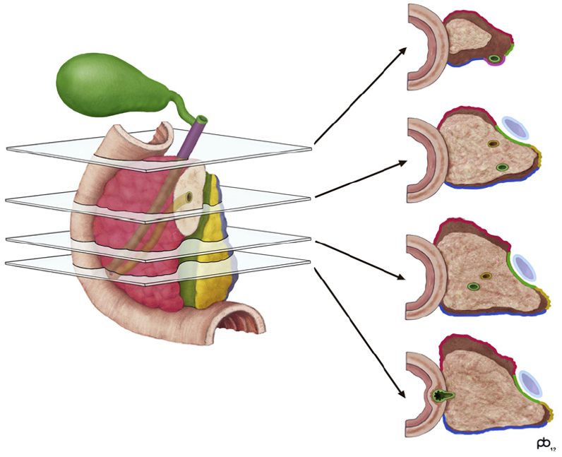 Pancreaskreft - Figur 7.png