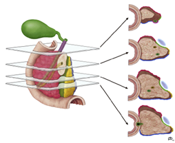 Figur 7. Ved aksial oppskjæring skjæres pancreashodet i parallelle skiver i det planet som står vinkelrett på lengde¬aksen av pars descendens duodeni. I hver disseksjonsskive sees de forskjel-lige circumferente preparat-overflater. Den blå strukturen i de tre nederste disseksjonsskivene representerer v. mesenterica superior. Hentet fra Verbeke (2013). Copyright 2013 Elsevier. Gjengitt med tillatelse.
