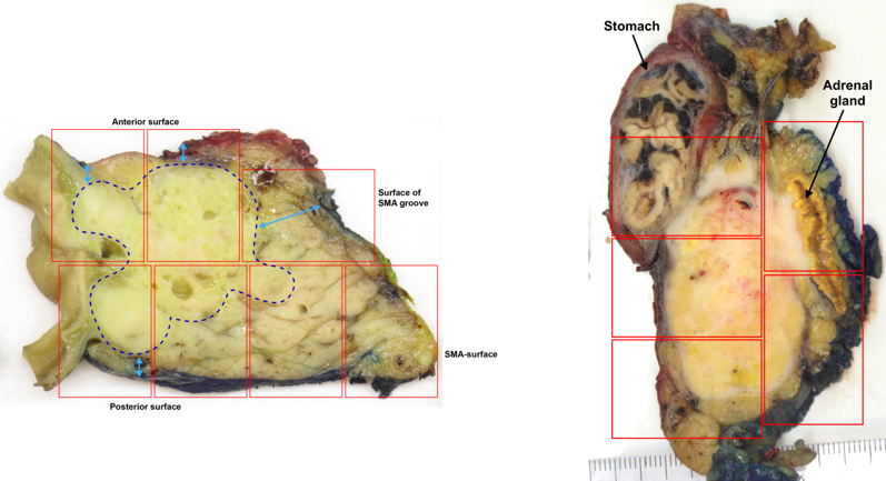 Figur 9: En-bloc snittuttak tillater optimal vurdering av tumors størrelse, relasjon til anatomiske strukturer og reseksjonsrendene, og peripancreatiske lyfemknuter (til venstre: aksial skive fra et pancreatoduodenectomipreparat, til høyre: sagittal skive fra et utvidet distalt pancreasresektat inkl. ventrikkelsegment og venstre binyre).
