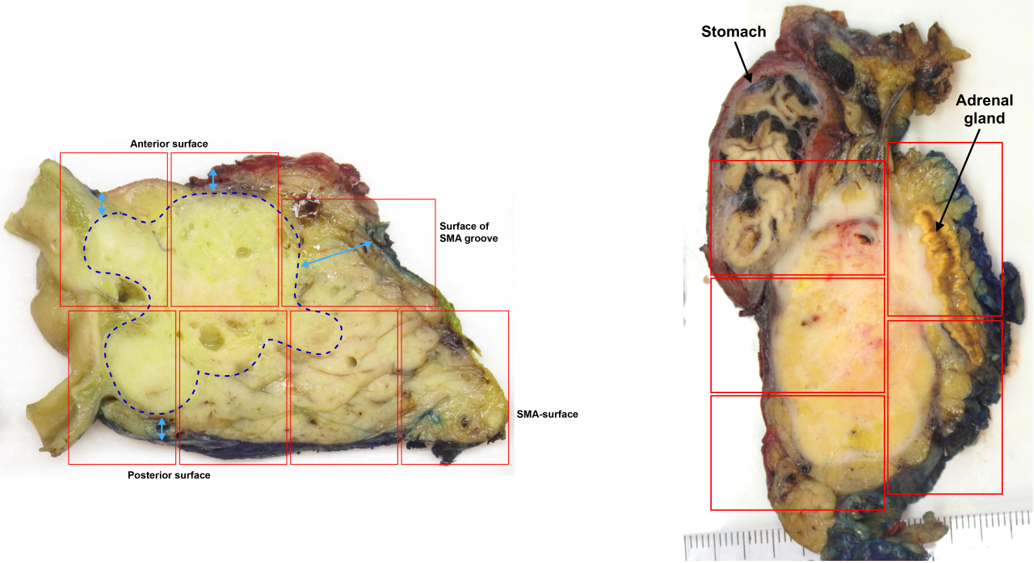 Figur 9. En-bloc snittuttak tillater optimal vurdering av tumors størrelse, relasjon til anatomiske strukturer og  reseksjonsrendene, og peripancreatiske lyfemknuter (til venstre: aksial skive fra et pancreatoduodenectomipreparat, til høyre: sagittal skive fra et utvidet distalt pancreasresektat inkl.  ventrikkelsegment og venstre binyre). Hentet fra Campbell et al. (2021). Copyright 2021 Springer. Gjengitt med tillatelse.