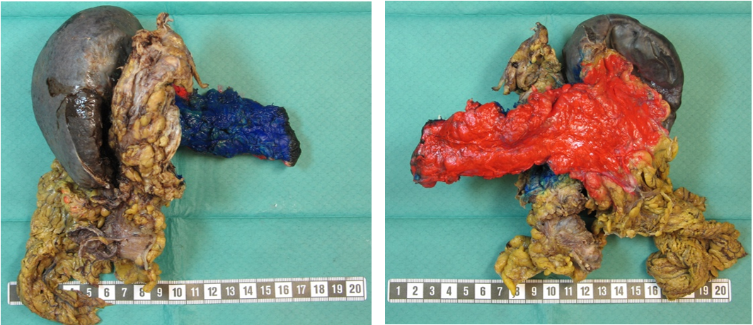 Figur 6. Den circumferente reseksjonsranden i distale pancreasresektater består av den anteriore (rød) og posteriore overflaten (blå). Hentet fra American College of Surgeons and the Alliance for Clinical Trials in Oncology et al. (2015). Copyright 2015 Walters Kluwer. Gjengitt med tillatelse. 