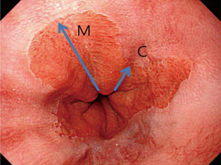 Spiserørskreft - CM klassifikasjon av Barretts øsofagus.png