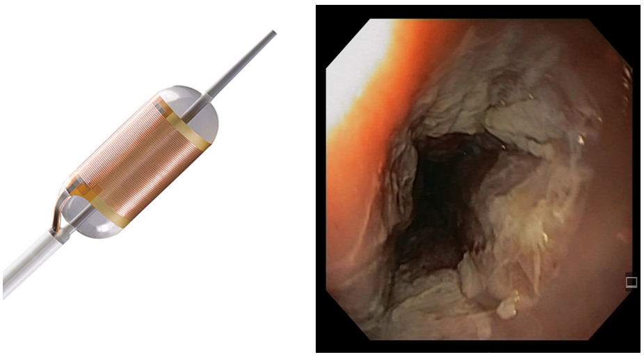 Spiserørskreft - Rasiofrekvens ablasjon (RFA) i spiserøret.png