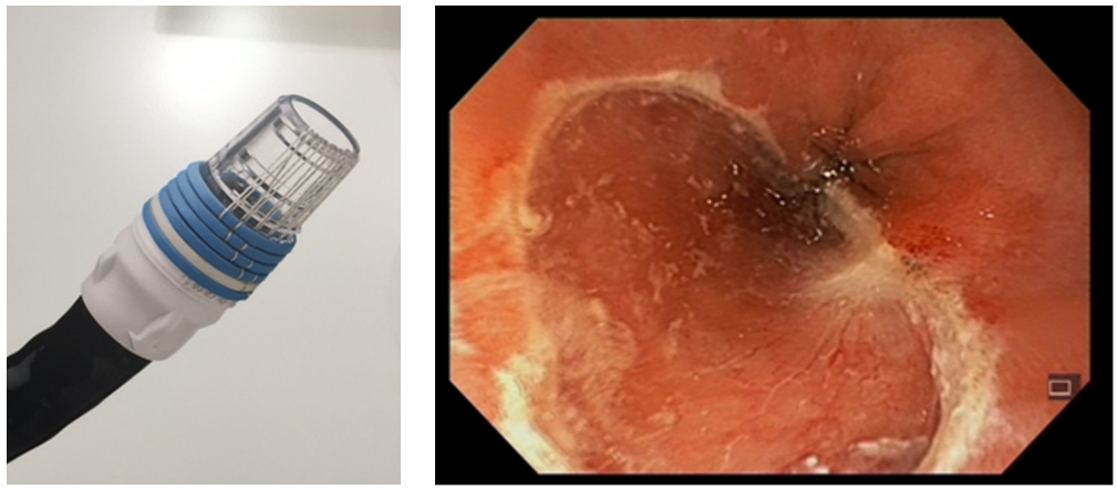 Spiserørskreft - Gummibånd EMR.png