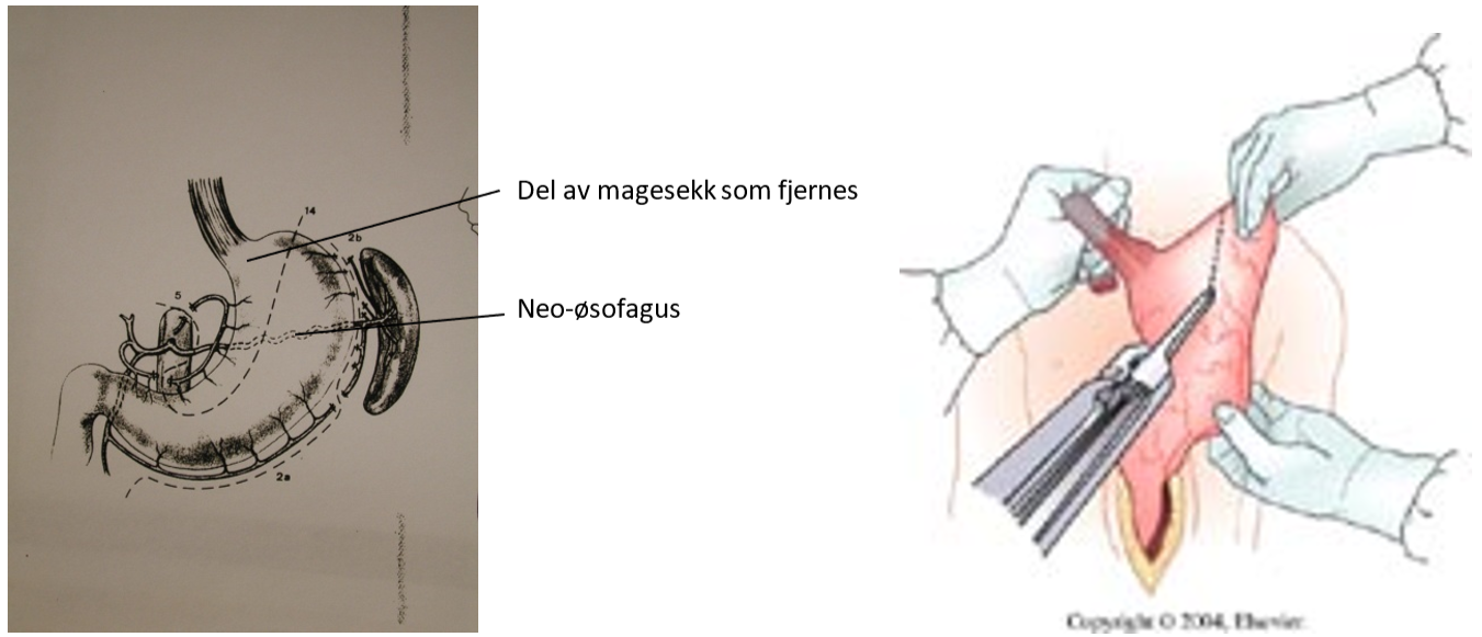 Spiserørskreft - Teknikk ved konstruksjon av magesekkrør.png