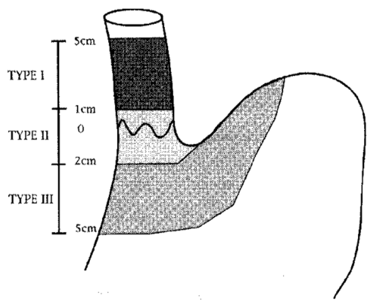 Spiserørskreft - Siewerts klassifikasjon.png