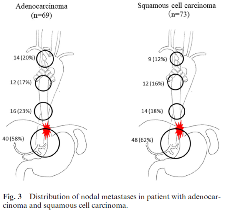 Spiserørskreft - Distribution of nodal metastases.png